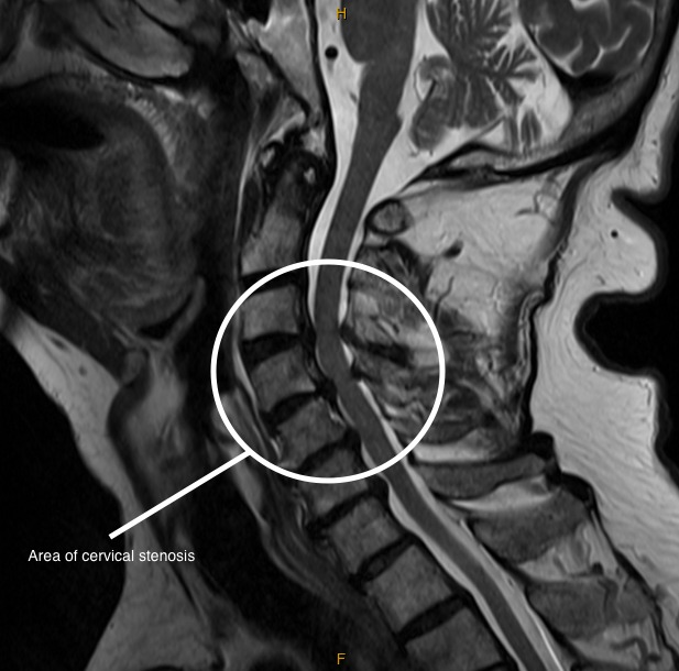 RMN / imagine stenoză de canal vertebral