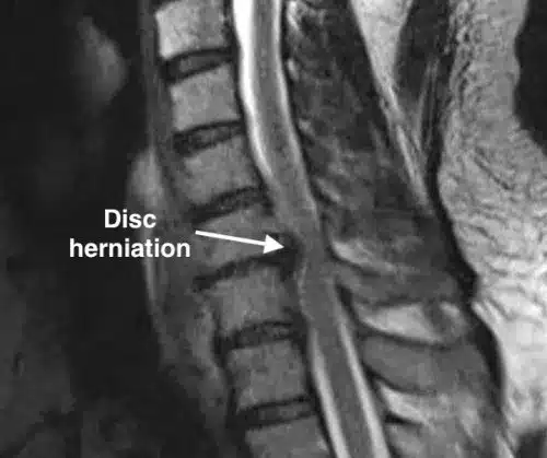 RMN coloană cervicală – hernie de disc