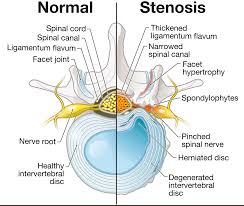 Comparativ: coloană normală vs canal stenozat
