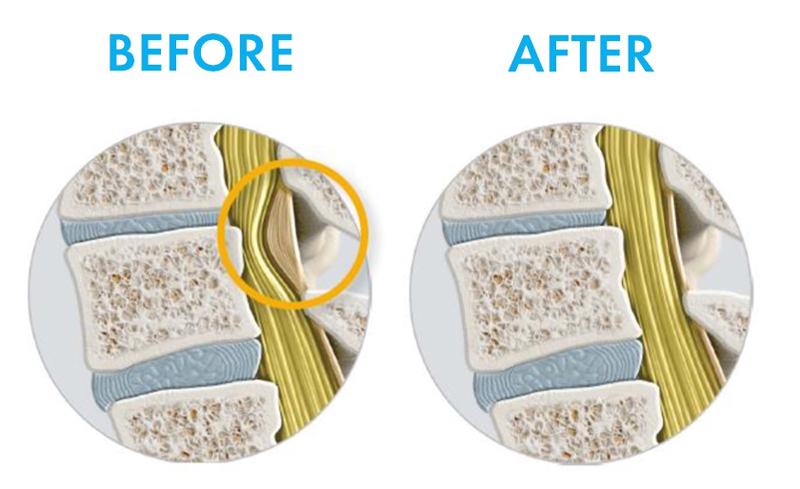 Stenoză de canal – exemplu imagistic