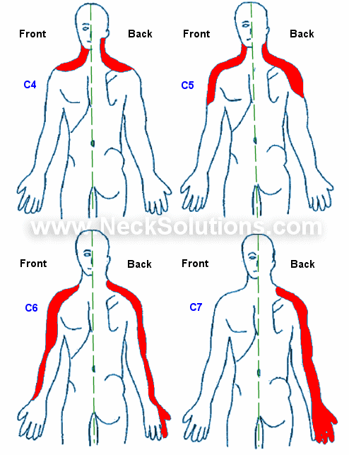 Distribuția durerii și simptomelor în hernia de disc cervicală