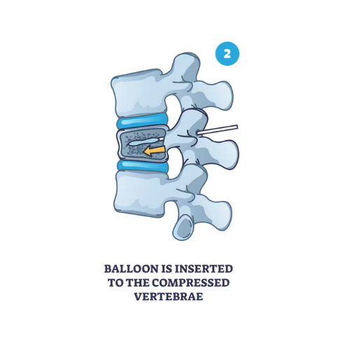 Balonul este inserat în vertebra tasată (kyphoplastie)