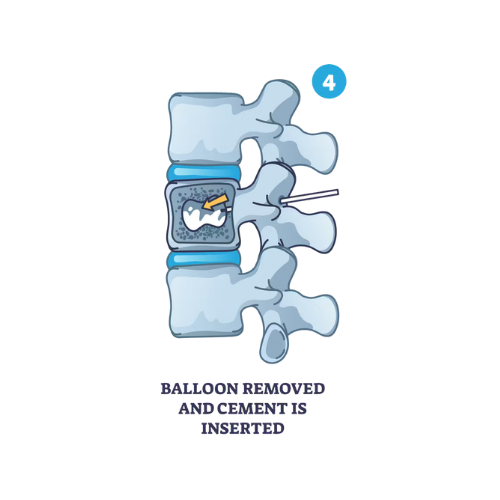 Balonul este scos și se injectează cimentul în cavitatea creată