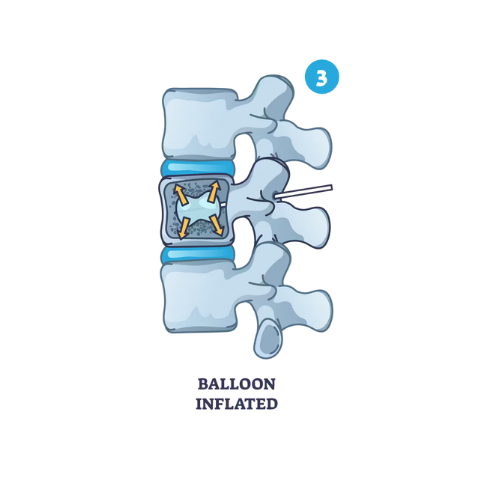 Balonul se umflă în corpul vertebral pentru a crea cavitatea și a restaura parțial înălțimea