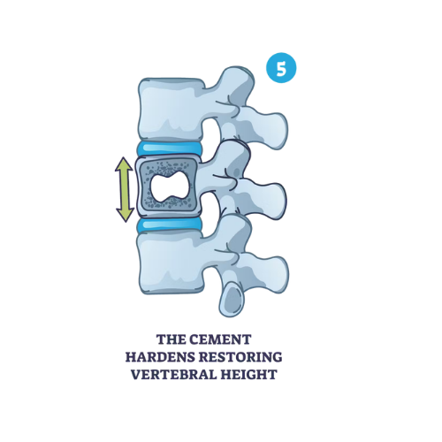 Cimentul se întărește, stabilizând corpul vertebral și susținând înălțimea