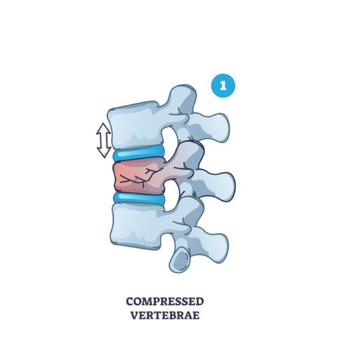 Vertebră tasată – corp vertebral lombar (fractură compresivă)